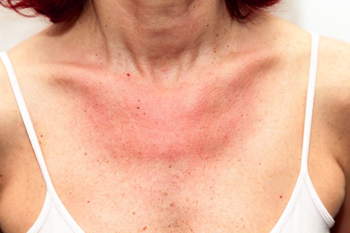 W przypadku alergii na słońce zmiany skórne występują głównie na dekolcie, szyi, przedramionach, ramionach i na stopach, rzadziej na twarzy.