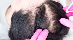 Badanie hormonów tarczycy w kierunku łysienia