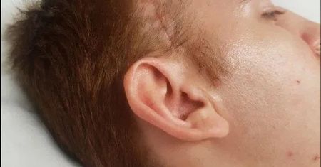 Opuchlizna mózgu sprawiła, że lekarze wycięli mu połowę czaszki. Skutki wypadku samochodowego