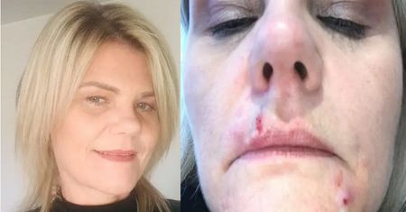 Zamówiła lifting z przeceny. Kobieta pozostała z ranami na twarzy