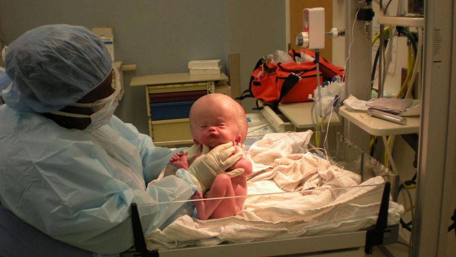 Urodził się z bardzo opuchniętą głową