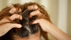 Łuszczyca głowy - przyczyny, objawy, leczenie