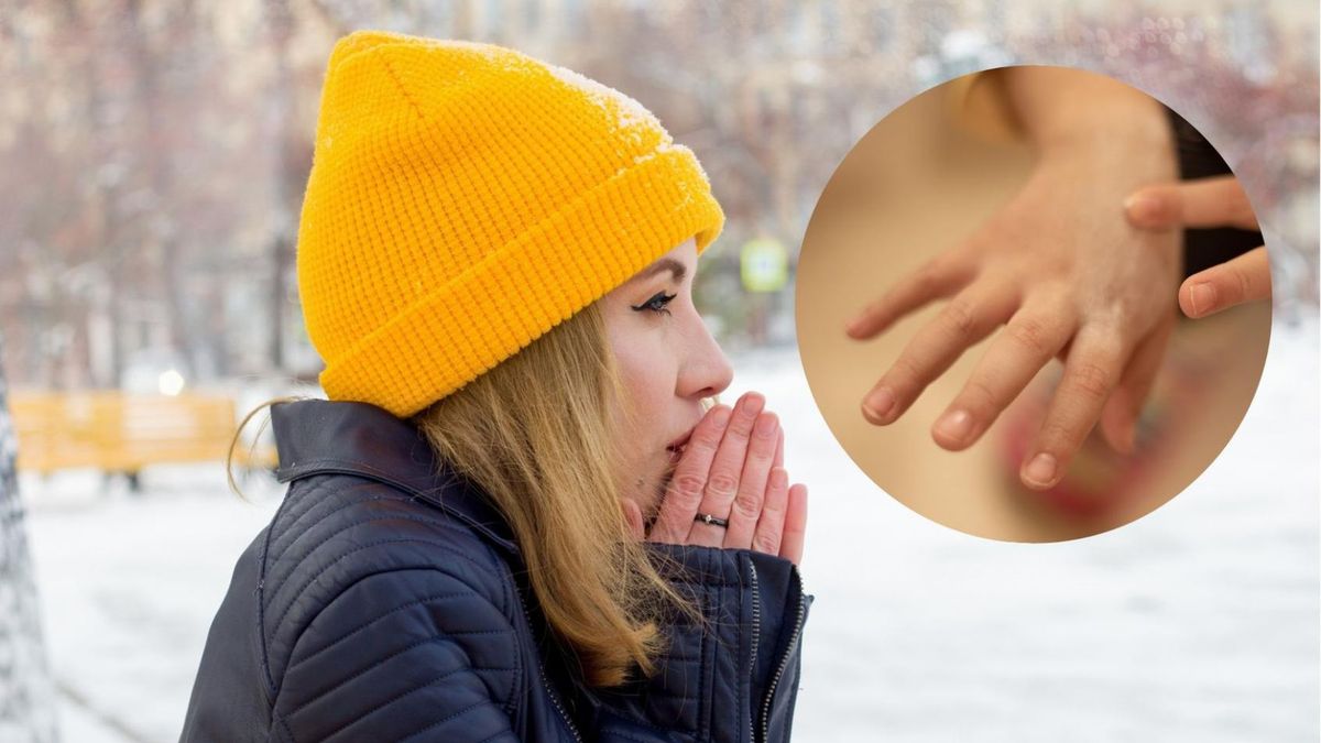 Ujemne temperatury mogą wywołać tzw. pokrzywkę z zimna. Na skórze pojawiają się swędzące bąble