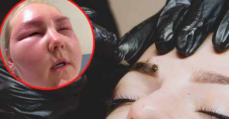 Bała się, że będzie musiała odwołać ślub. Przez wizytę u kosmetyczki straciła wzrok i trafiła do szpitala