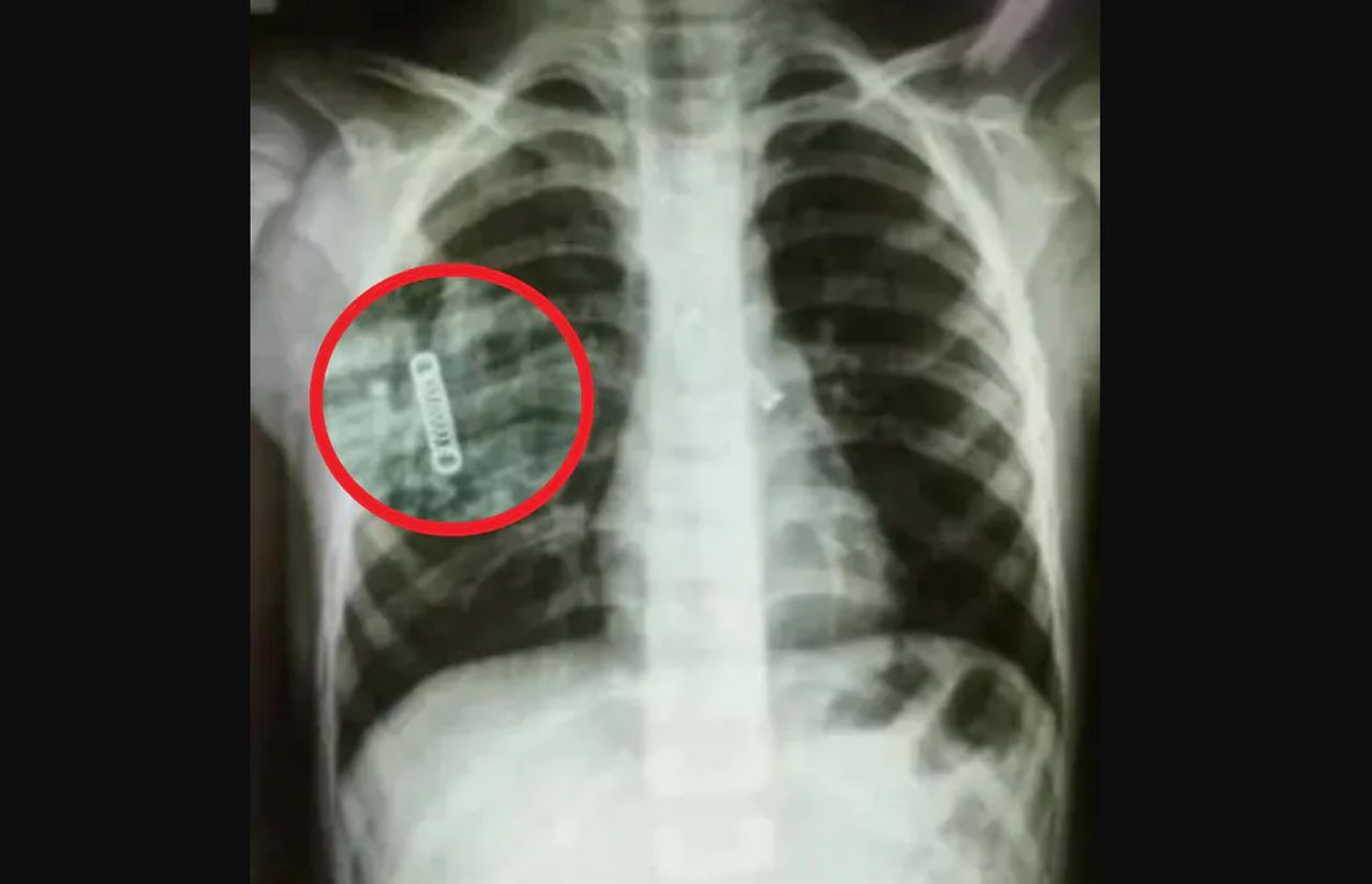 5-latek kaszlał od miesięcy. Lekarze nie mogli uwierzyć w obraz z prześwietlenia