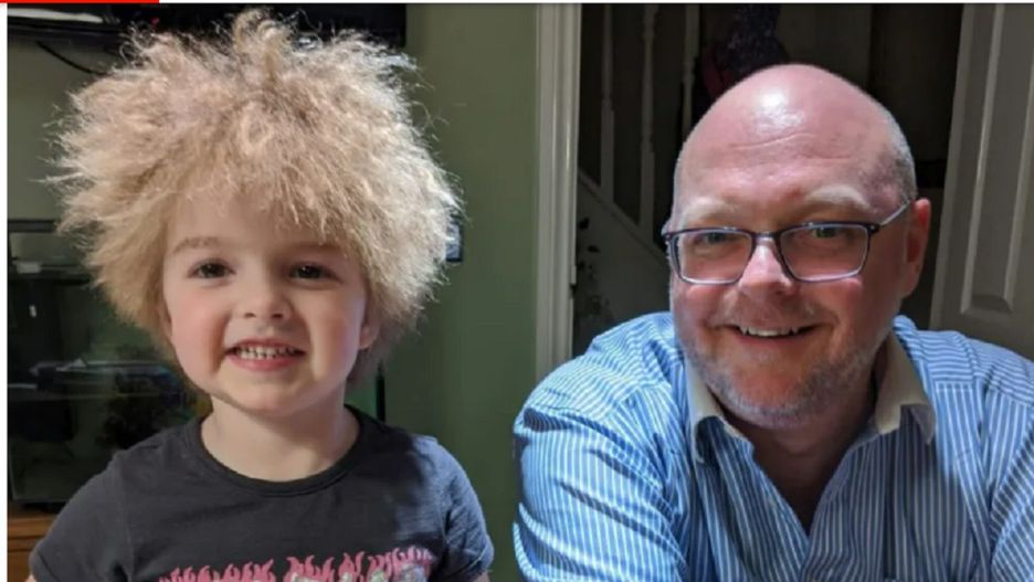 Dziewczynka cierpi na bardzo rzadką chorobę. "Ma fryzurę jak Einstein"