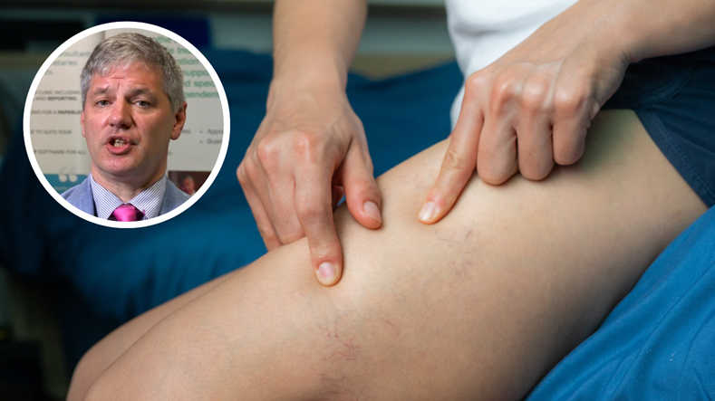 Żylaki to nie tylko problem estetyczny. Styl życia ma ogromne znaczenie