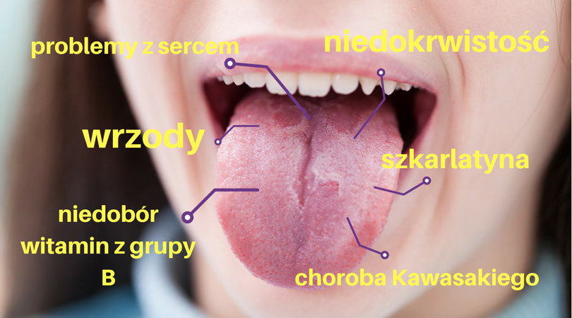 Biały nalot na języku świadczy o kłopotach z żołądkiem