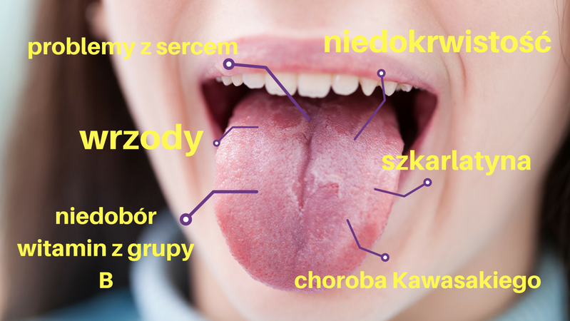 Biały nalot na języku świadczy o kłopotach z żołądkiem