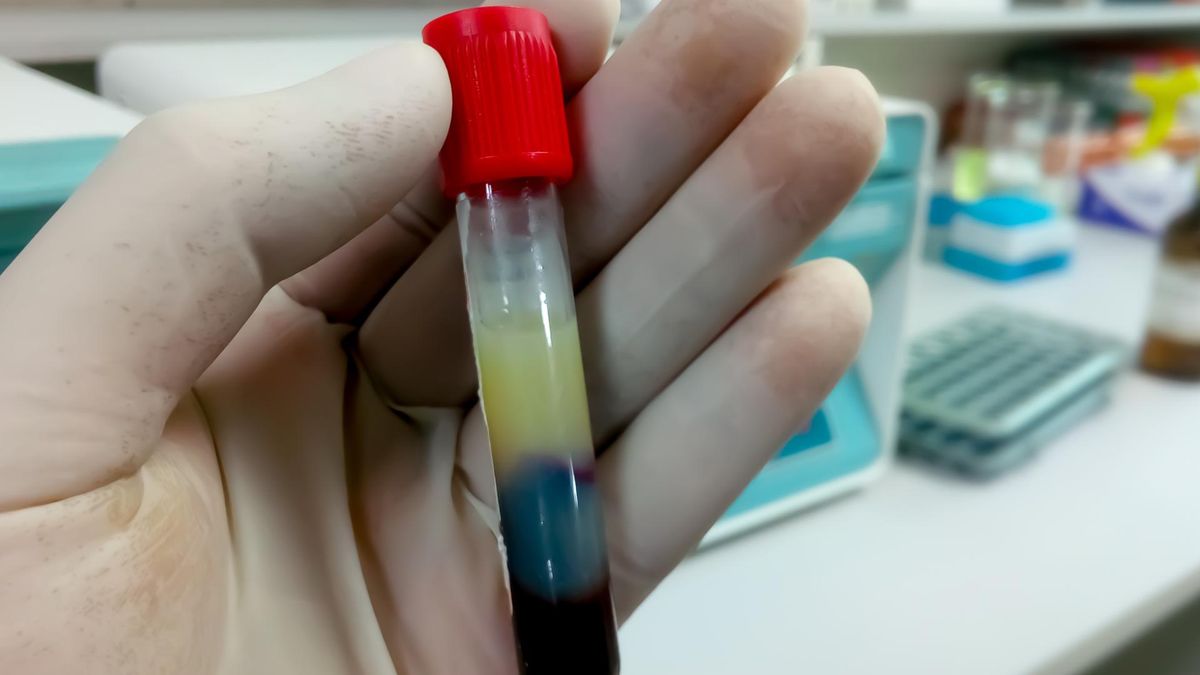 Masz wysoki cholesterol? To nie tylko kwestia diety. Zobacz 10 nieoczywistych przyczyn