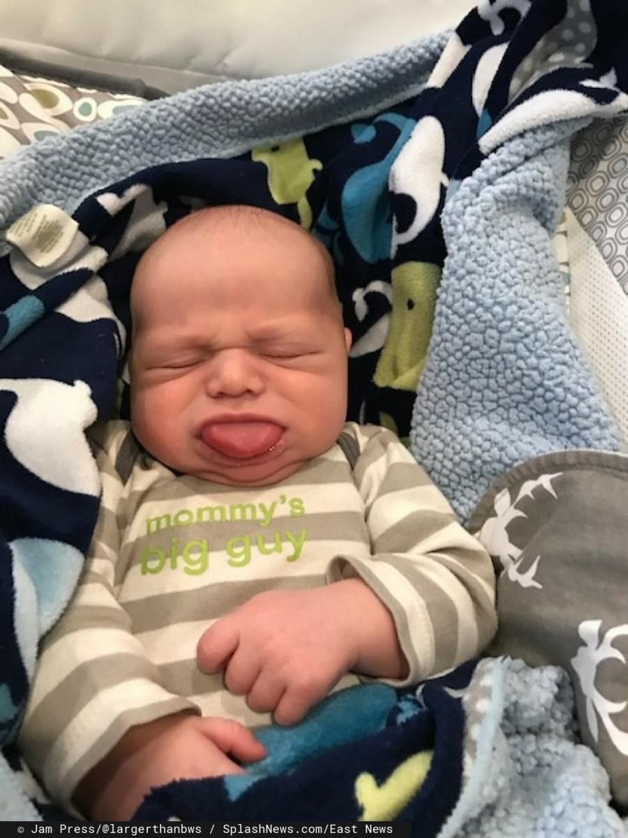 Chorobę Owena zdiagnozowano 2 tyg. po porodzie