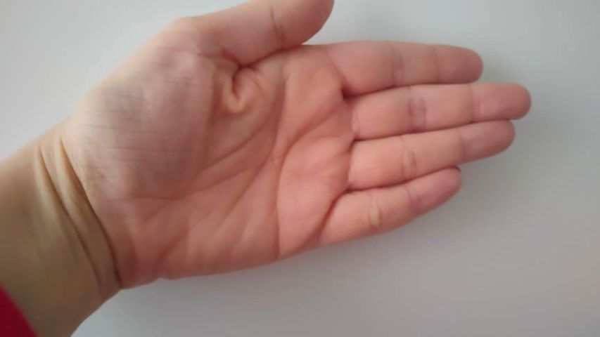 Zmiany po wewnętrznej stronie dłoni mogą świadczyć o zbyt wysokim cholesterolu