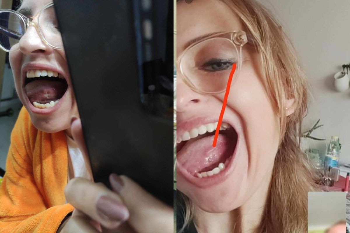 Pierwsze zdjęcie pochodzi z sierpnia, drugie z września. Marzena mówi, że zmiana rośnie, rośnie też ryzyko przerzutów