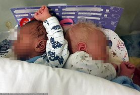 Dwukolorowe bliźnięta urodziły się w łódzkim szpitalu. To pierwsze takie dzieci urodzone w Polsce