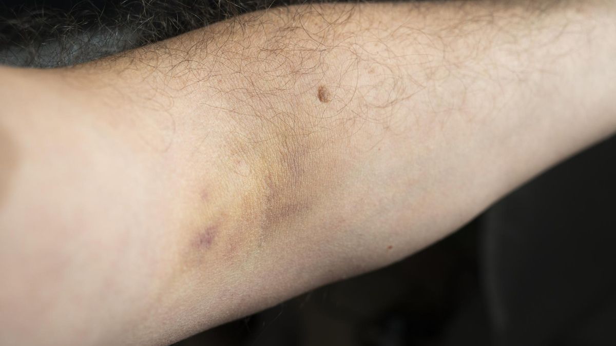 Cukrzyca typu 2. Pierwsze objawy widać na skórze