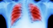 Nie palili, a zachorowali na raka płuc. Naukowcy ustali przyczyny