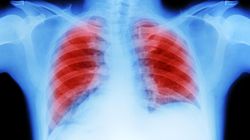 Nie palili, a zachorowali na raka płuc. Naukowcy ustali przyczyny