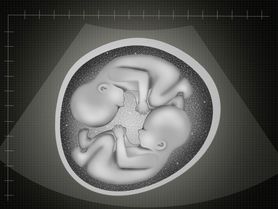 Bliźniacza ciąża - bliźnięta jednojajowe i dwujajowe, zagrożenia