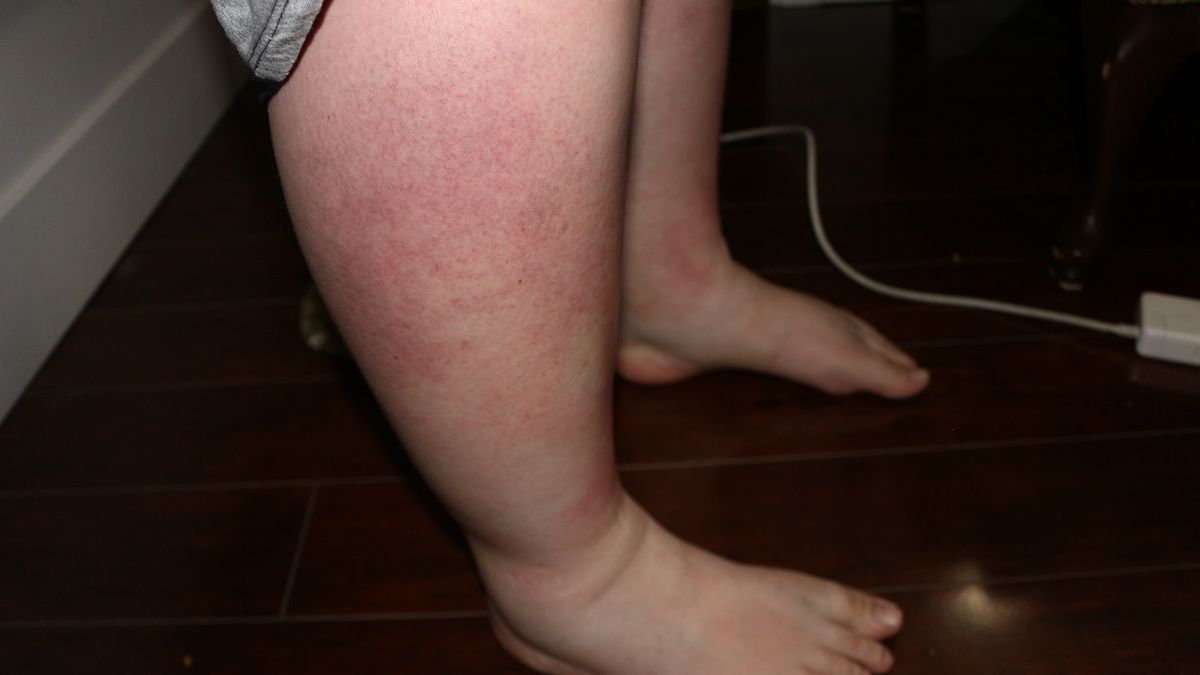 Siniaki, swędząca skóra, ciemny mocz. Tak objawia się chora wątroba