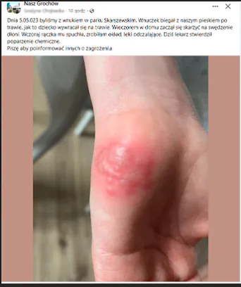 Do poparzeń może dojść w parku