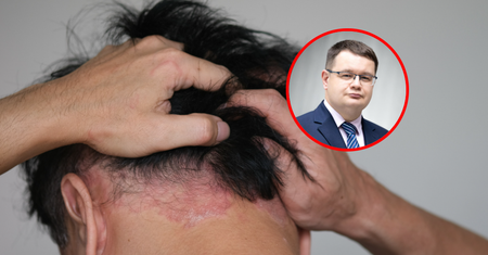 Skóra głowy pod lupą. Dermatolog obala mity