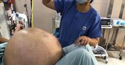 Największy guz jajnika na świecie. Ważył 50 kg