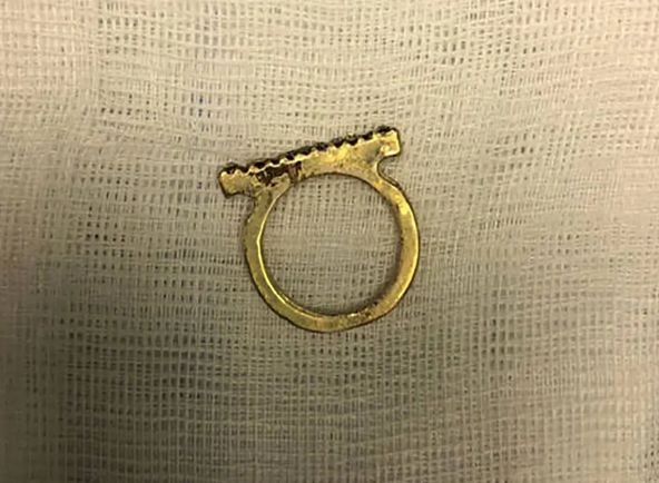 2-latek połknął pierścionek