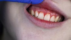 Odsłonięte szyjki zębowe - przyczyny, objawy, leczenie, nadwrażliwość zębów