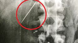 RTG ujawnia nietypowe znalezisko. Mężczyzna od 15 lat żyje z igłą w wątrobie