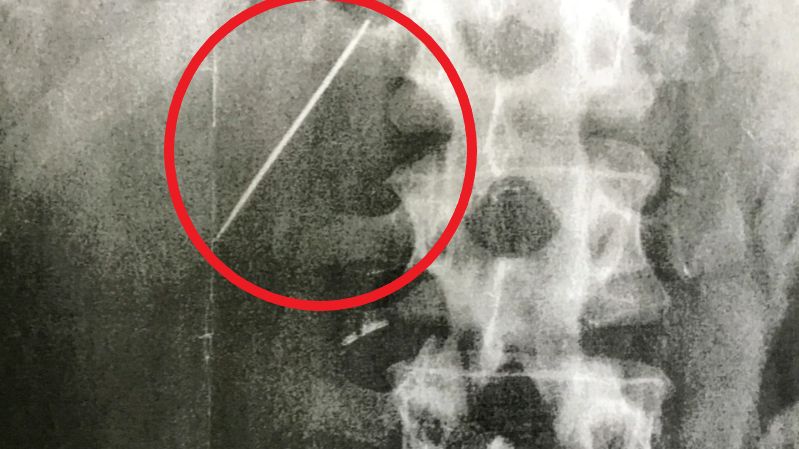 RTG ujawnia nietypowe znalezisko. Mężczyzna od 15 lat żyje z igłą w wątrobie