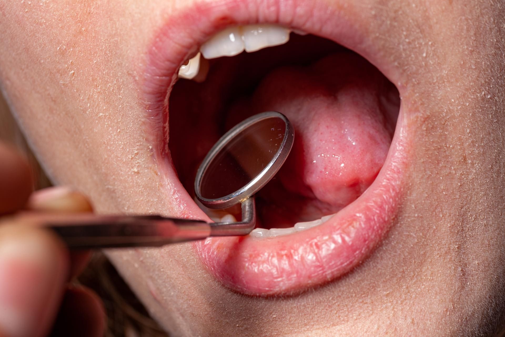 Rakowi jamy ustnej moze sprzyjać przetworzona żywność