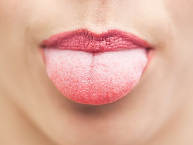 Biały nalot na języku pojawia się w przebiegu różnego rodzaju chorób