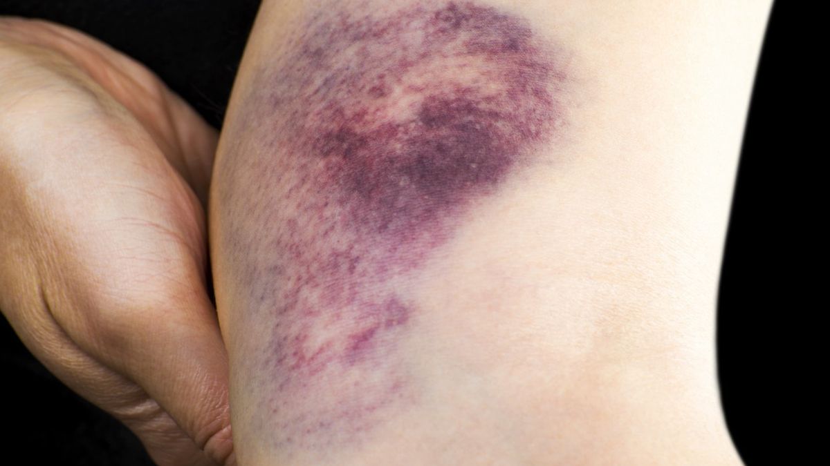 Wyróżniamy kilka rodzajów krwiaka, np.: tętniczy, śródczaszkowy, podpaznokciowy.