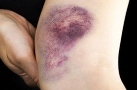 Krwiak - przyczyny, objawy, leczenie