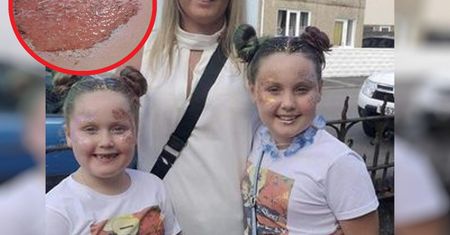 Dramat po zabawie na zjeżdżalni. Tak wygląda noga 9-latki