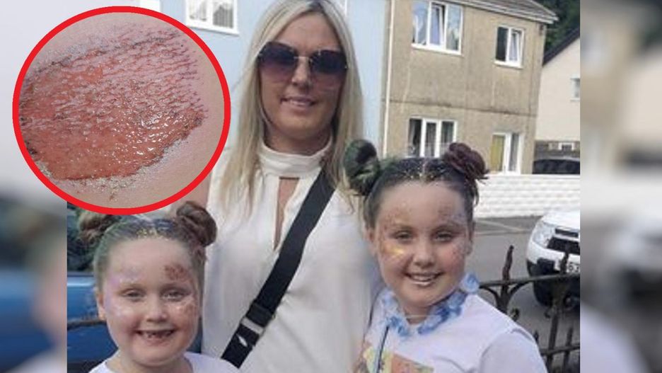 Zabawa skończyła się poparzeniem nogi