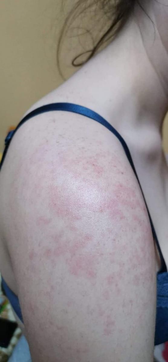 Monika walczy z powikłaniami po COVID-19 od pięciu miesięcy