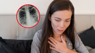 Zapalenie płuc groźniejsze niż się wydaje. "Czasem ujawnia nowotwór"