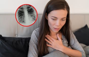 Zapalenie płuc groźniejsze niż się wydaje. "Czasem ujawnia nowotwór"