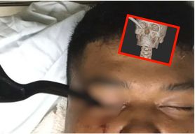 Hamulec utkwił w jego oku podczas wypadku. Lekarze pokazali zdjęcia