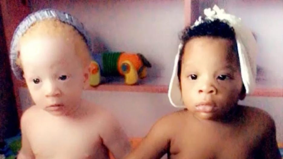 Bliźniaki o różnym kolorze skóry