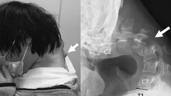 Skutek uzależnienia od smartfona. 25-latek z "syndromem opadającej głowy"