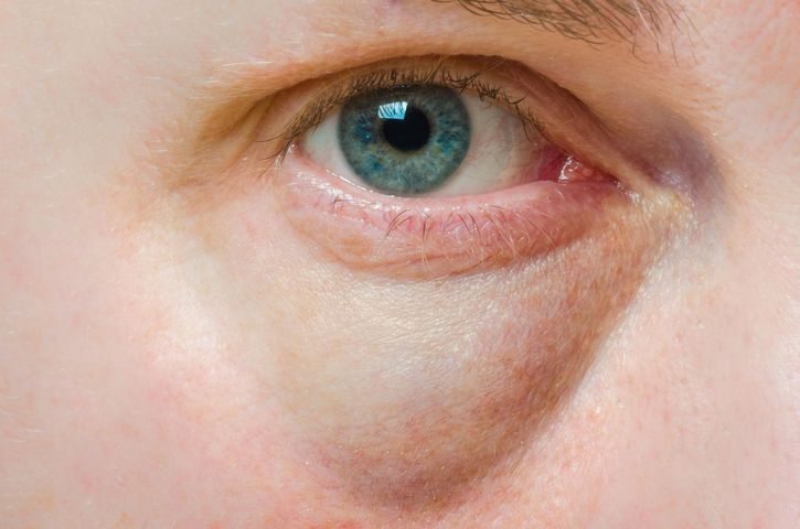 Worki pod oczami mogą być objawem wielu chorób