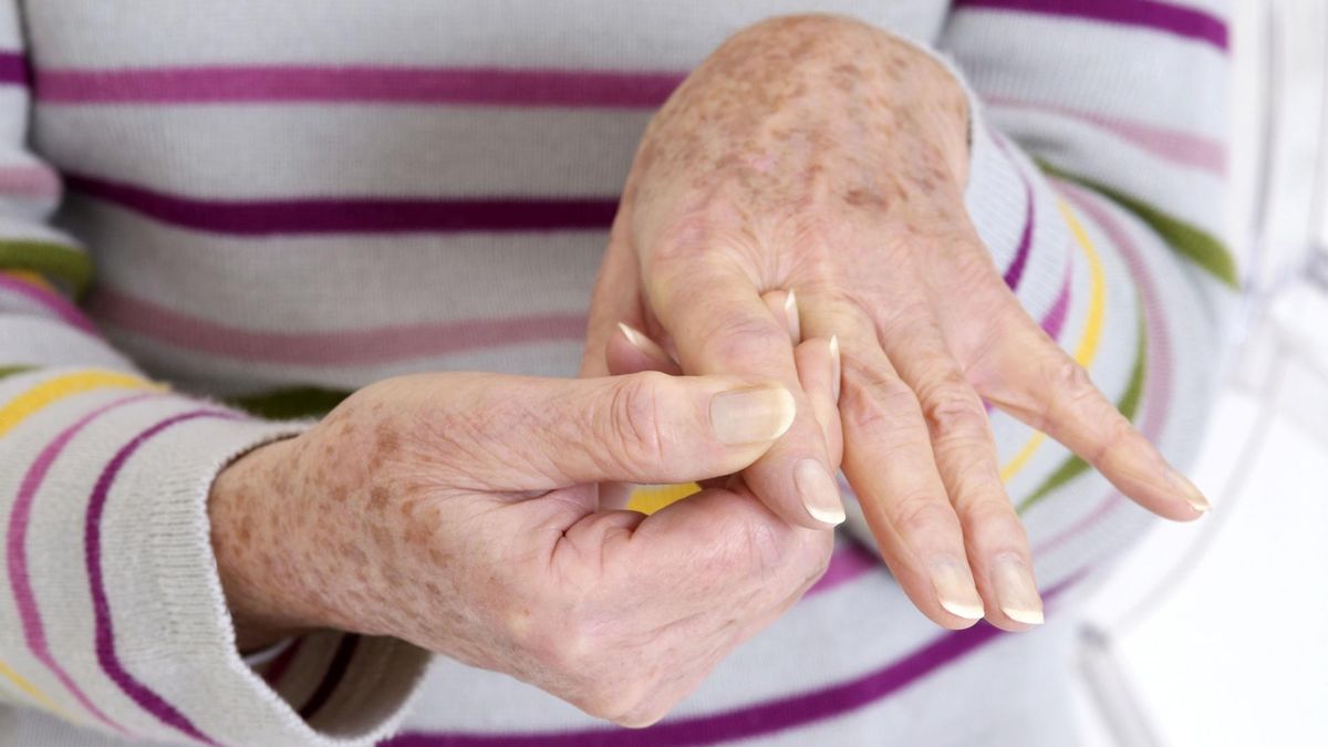 Wyrośla i grudki kostne na dłoniach. To może być wczesny objaw choroby zwyrodnieniowej stawów