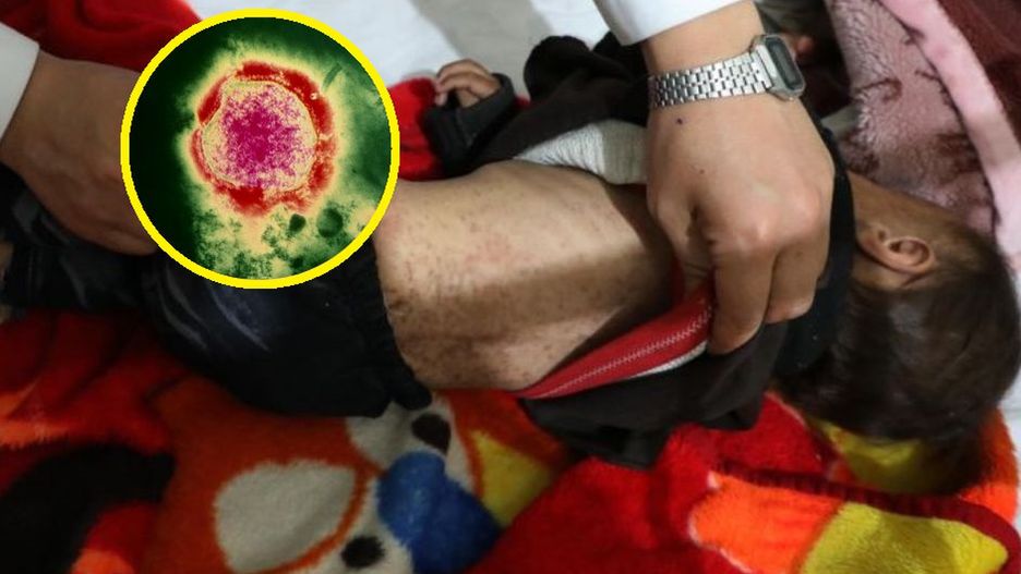 WHO ostrzega przed odrą. Główny Inspektorat Sanitarny apeluje do rodziców