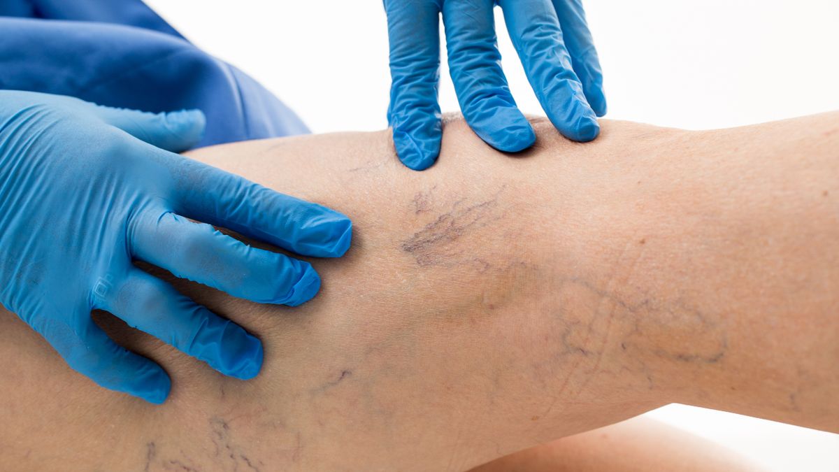 DIH polecany jest pacjentom z objawami niewydolności żylnej kończyn dolnych.