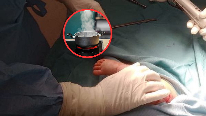 Na niemowlę wylał się wrzątek z termosu. Lekarze musieli działać szybko