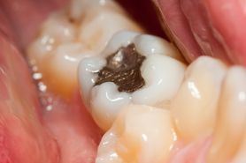 Zakaz wchodzi w życie 1 stycznia. Tego już nie zrobisz u dentysty