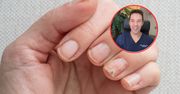 Masz takie zmiany na paznokciach? Zobacz, co oznaczają