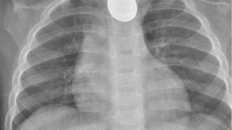 Co zrobić, gdy dziecko połknie baterię. "Gdybyśmy dotarli 10 lub 15 minut później, może nie udałoby mu się przeżyć"